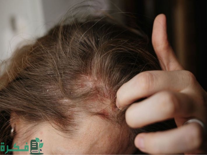 طرق علاج اكزيما الشعر 12 سبب لاكزيما الشعر 1 الإكزيما في الشعر