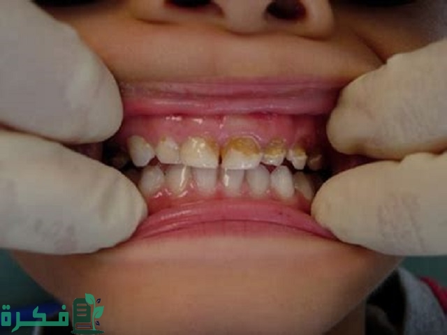 كيف تفرق بين ألم تسوس الأسنان والتهاب اللثة 1 كيف تفرق بين ألم تسوس الأسنان والتهاب اللثة؟