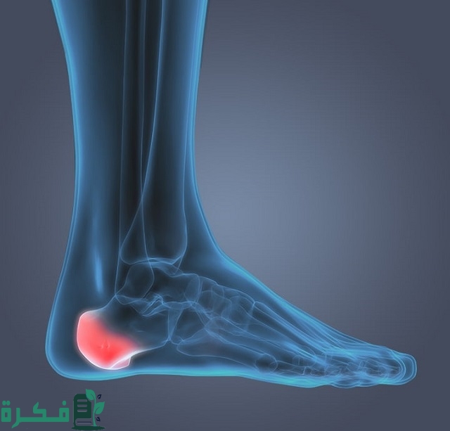 أسماء احسن 5 أنواع مرهم لعلاج الشوكة العظمية 1 أفضل 5 أنواع مرهم لعلاج الشوكة العظمية