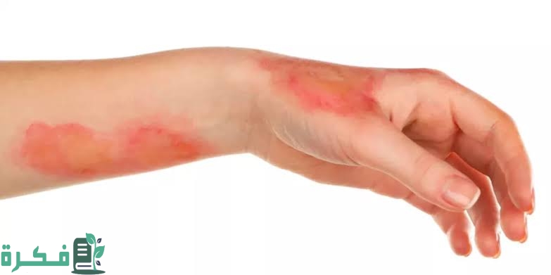 أسماء احسن 5 أنواع كريم للحروق من الدرجة الثانية 1 images 2023 03 06T214609.169 1
