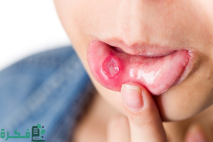 أسماء احسن 5 أنواع جل لعلاج قروح الفم 1 أفضل 5 أنواع جل لعلاج قروح الفم