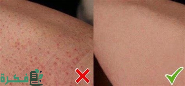 شرح خطوات إزالة الشعر تحت الجلد في الساقين 4 طرق تعرفي عليها 1 كيفية إزالة الشعر تحت الجلد في الساقين