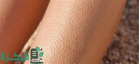 أسماء احسن الكريمات الطبية والمرطبات لعلاج مشكلة جلد الدجاجة 1 أفضل الكريمات الطبية والمرطبات لعلاج مشكلة جلد الدجاجة