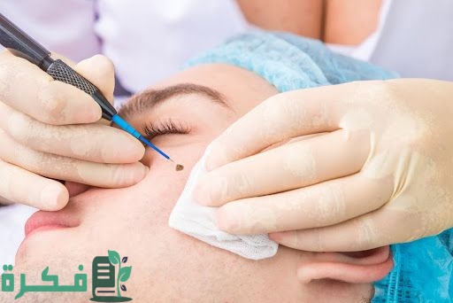شرح خطوات التخلص وإزالة الشامات المسطحة 1 كيفية التخلص من الشامات المسطحة