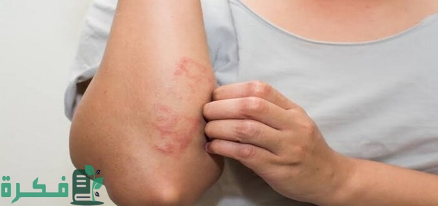 هل الجرب يبقى في الملابس; 5 طرق للوقاية 1 هل الجرب يعيش في الملابس