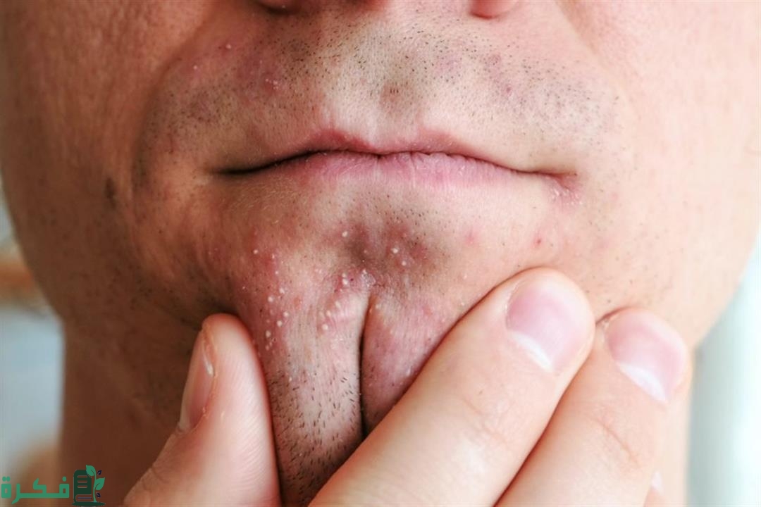 هل هناك علاقة بين ظهور الحبوب وممارسة الجنس 1 هل هناك علاقة بين ظهور الحبوب وممارسة الجنس