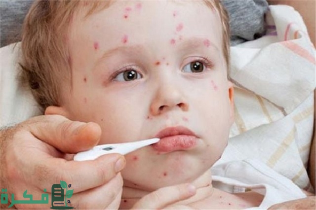 أسباب ظهور حبوب برؤوس مائية عند الأطفال 1 ما أسباب ظهور حبوب برؤوس مائية عند الأطفال؟