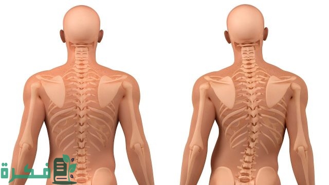 أنواع تقوس الظهر بالصور أنواع تقوس الظهر بالصور
