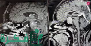 مستشفى الدكتور سليمان الحبيب يستأصل ورماً بالبروستاتا باستخدام التقنيات الحديثة Hollep 1 مستشفى الدكتور سليمان الحبيب بالفيحاء في جدة يستأصل ورماً بالبروستاتا بتقنية Hollep الحديثة وبتخدير جزئي