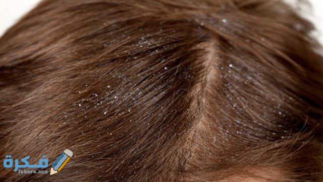 علاج صيبان الشعر