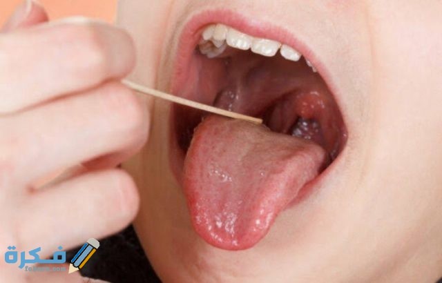 السن المناسب لإزالة اللحمية عند الأطفال