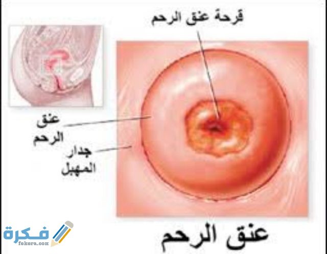 تجربتي في علاج قرحة الرحم وأبرز أسبابها وأعراضها