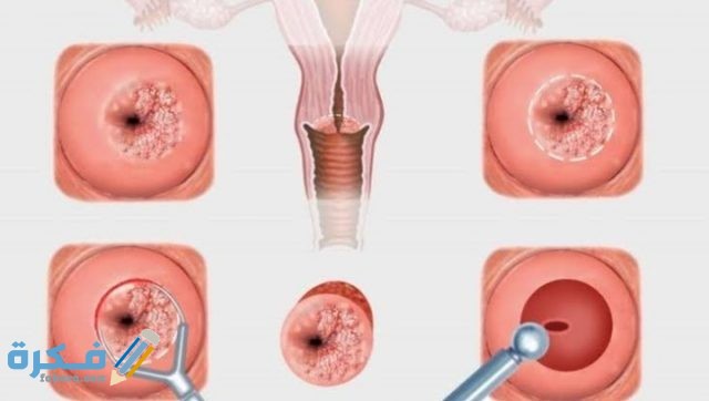 تجربتي في علاج قرحة الرحم وأبرز أسبابها وأعراضها