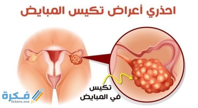 رجيم تكيس المبايض تجارب لمدة 7 أيام 