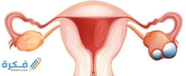 أعراض كيس على المبيض الأيمن وأنواع كيسات المبيض
