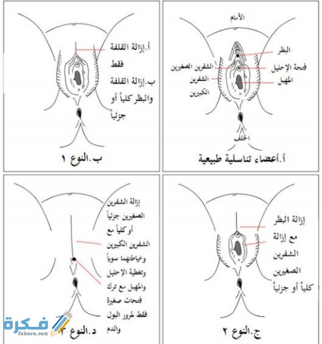 مراحل شفاء الختان بالصور للذكور والإناث
