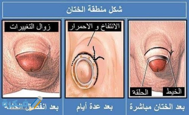 مراحل شفاء الختان بالصور للذكور والإناث
