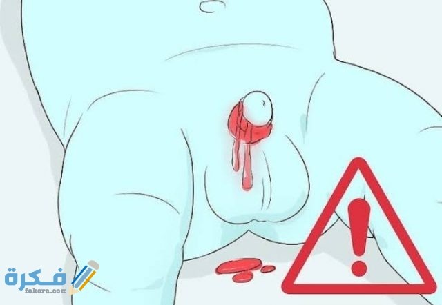 مراحل شفاء الختان بالصور للذكور والإناث