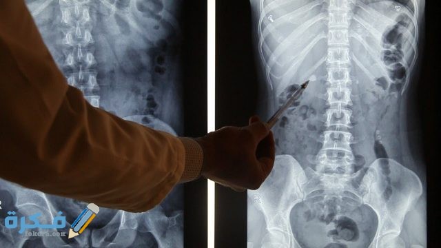 طرق تشخيص حصوات الكلى 
