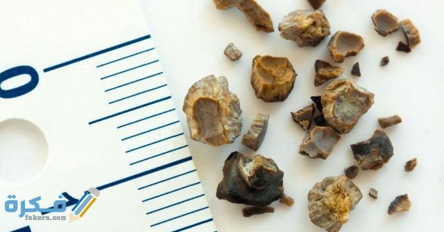 طرق علاج حصوات الكلى الصغيرة 