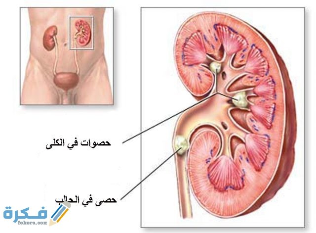 ما هي حصوات الكلى 