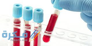 اجراءات اجراء فحص alkaline phosphatase في الدم 