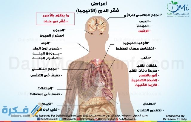 الأعراض العامة لفقر الدم 