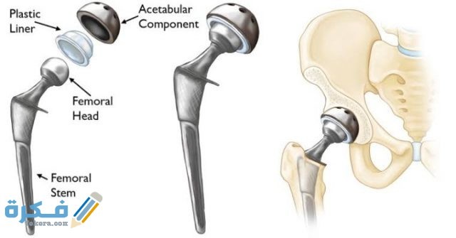 مفصل الورك الاصطناعي مصنوع من مادة 
