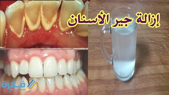 خلطة خل التفاح  للتخلص من جير الأسنان 