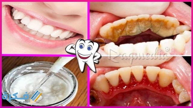 خلطة صودا الخبز  للتخلص من جير الأسنان 