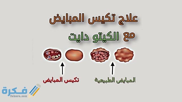 فوائد واعراض نظام كيتو الغذائي فوائد واعراض نظام كيتو الغذائي