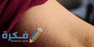 اسباب الاصابة بجلد الوزة 