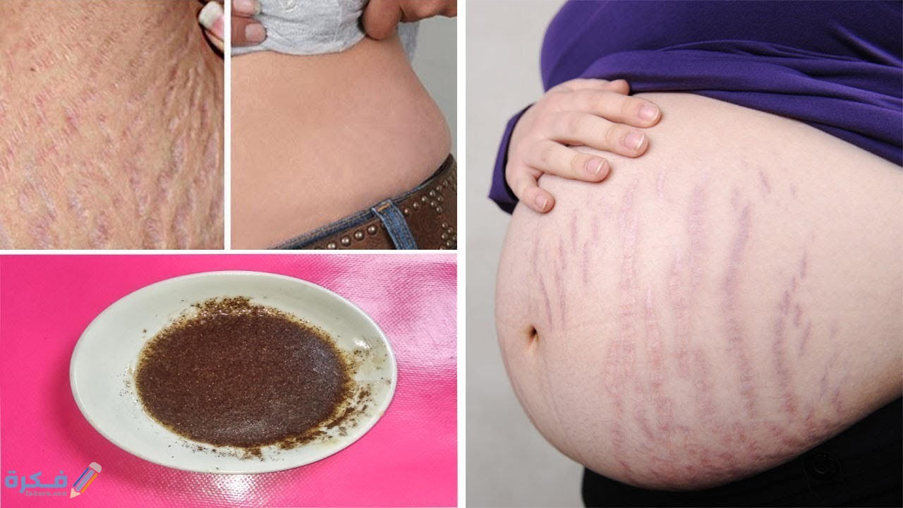 الطرق الطبية للتخلص من خطوط الجسم