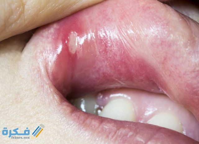 التخلص من قرحة الفم