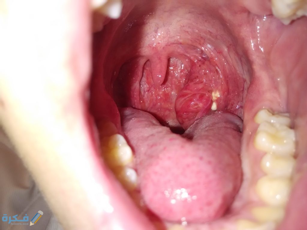  استخدام مسكنات الألم لتهدئة الألم المرتبط بآفة اللوز