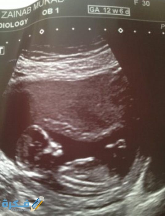 معرفة نوع الجنين من شكل الجمجمة