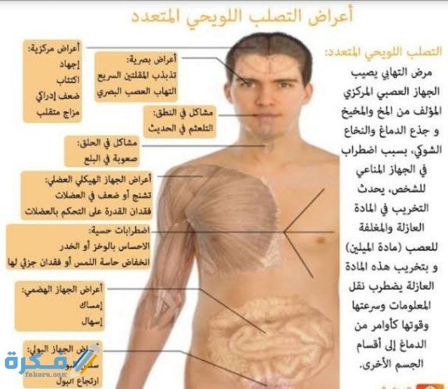 ما هو مرض التصلب اللويحي ما هو مرض التصلب اللويحي