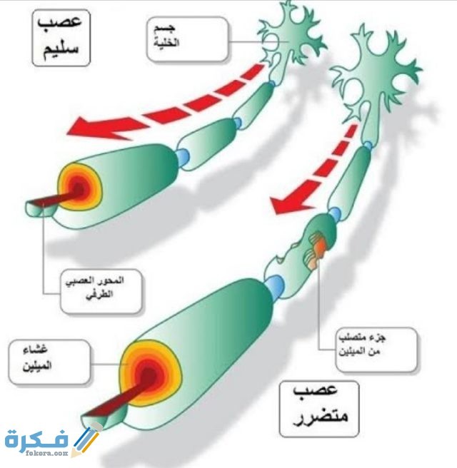 ما هو مرض التصلب اللويحي ما هو مرض التصلب اللويحي