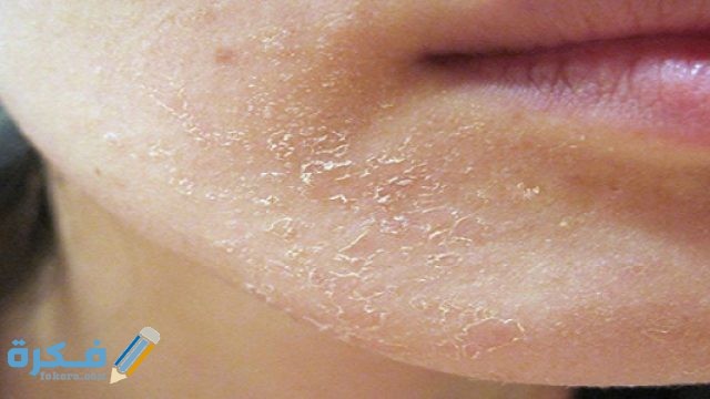 التخلص من قشور الوجه