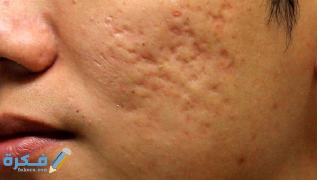 التخلص من ثقوب الوجه