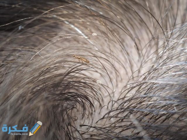 التخلص من صيبان الشعر