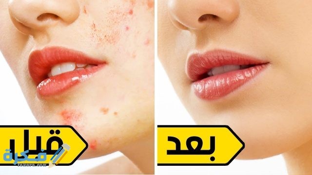 وصفات طبيعية للتقليل من حب الشباب 