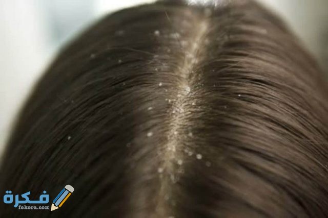 طرق-علاج-القمل-والصيبان