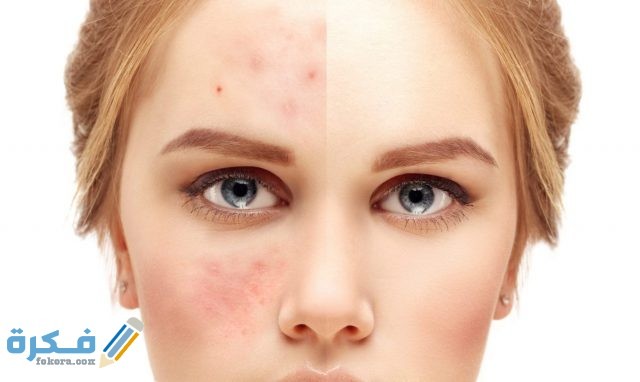 طرق التخلص من حب الشباب