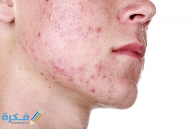 كيفية-التخلص-من-آثار-حب-الشباب