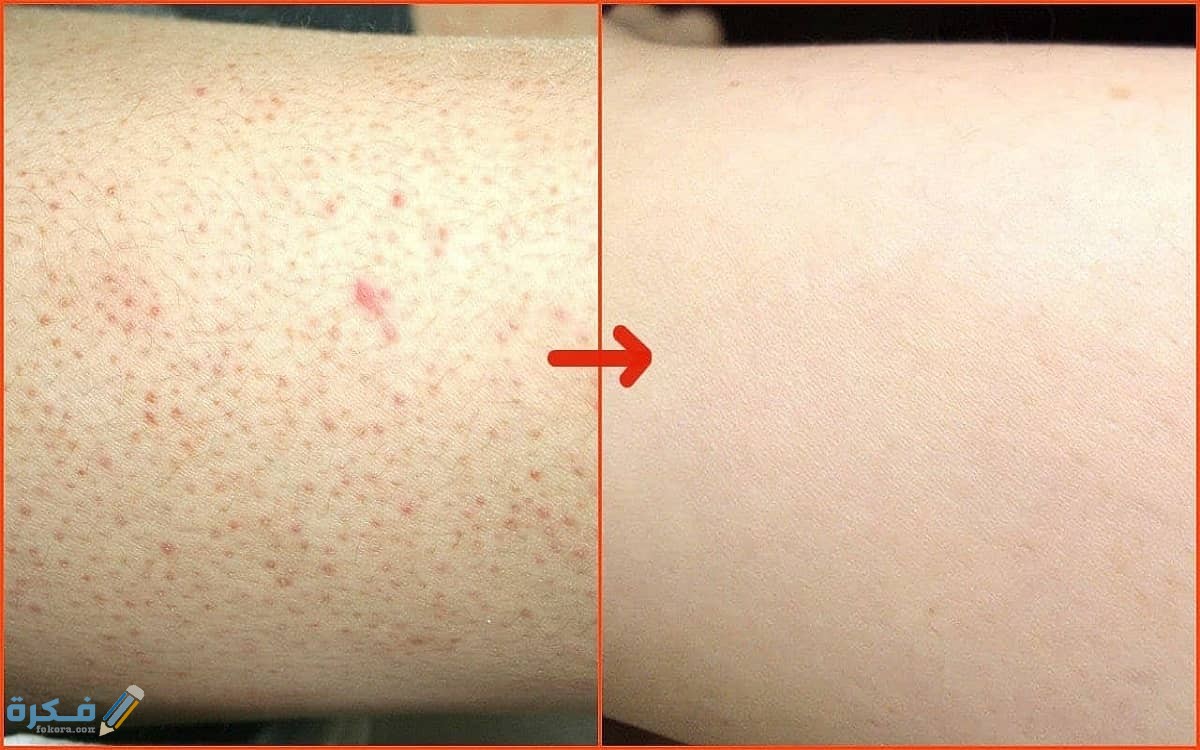 اسباب ظهور جلد الوزة