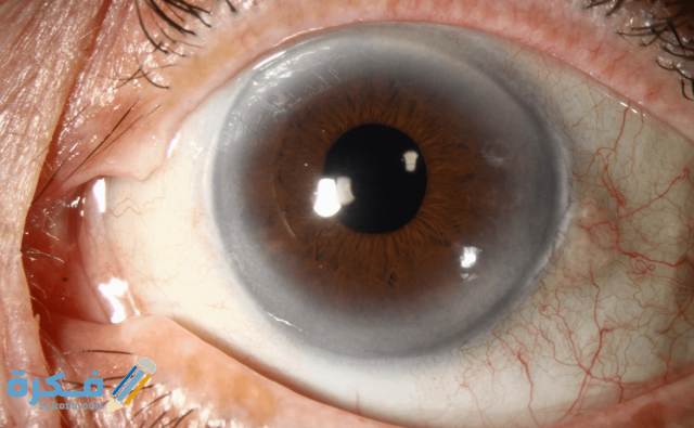 طريقة التخلص من ظفر العين