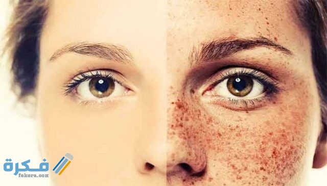طريقة التخلص من نمش الوجه