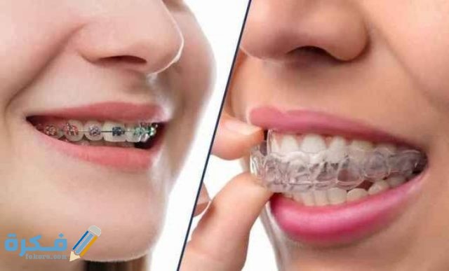 اسعار تقويم الاسنان في الاسكندرية