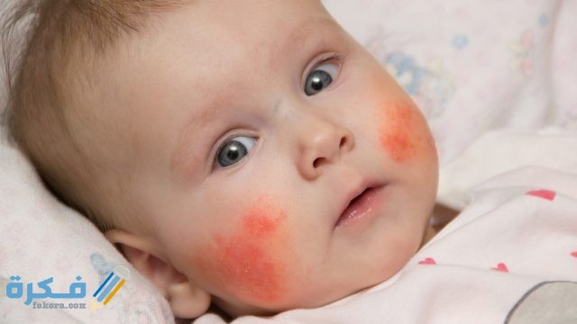 سبب احمرار جفن الرضيع وعلاجها